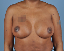 Breast Augmentation Before and After | Dr. Thomas Hubbard