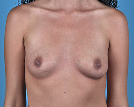 Breast Augmentation Before and After | Dr. Thomas Hubbard