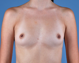 Breast Augmentation Before and After | Dr. Thomas Hubbard