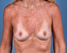 Breast Augmentation Before and After | Dr. Thomas Hubbard