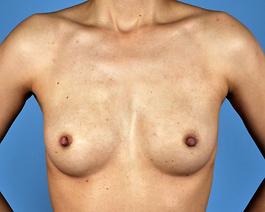 Breast Augmentation Before and After | Dr. Thomas Hubbard