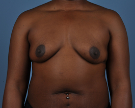 Breast Augmentation Before and After | Dr. Thomas Hubbard