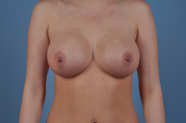 Breast Augmentation Before and After | Dr. Thomas Hubbard