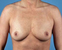 Breast Augmentation Before and After | Dr. Thomas Hubbard