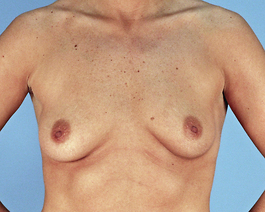 Breast Augmentation Before and After | Dr. Thomas Hubbard