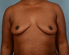 Breast Augmentation Before and After | Dr. Thomas Hubbard