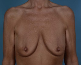 Breast Augmentation Before and After | Dr. Thomas Hubbard