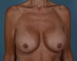 Breast Augmentation Before and After | Dr. Thomas Hubbard