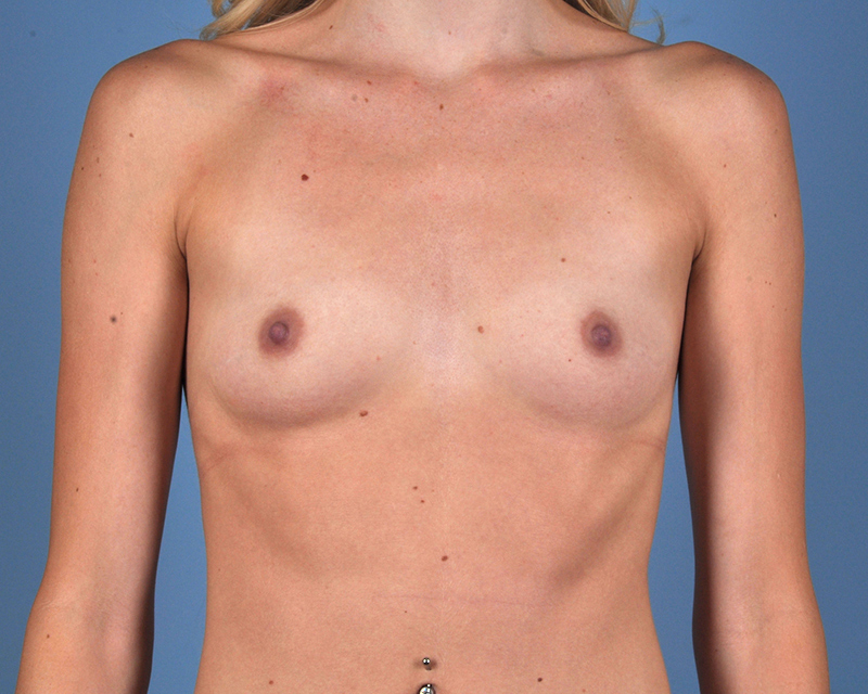 Breast Augmentation Before and After | Dr. Thomas Hubbard