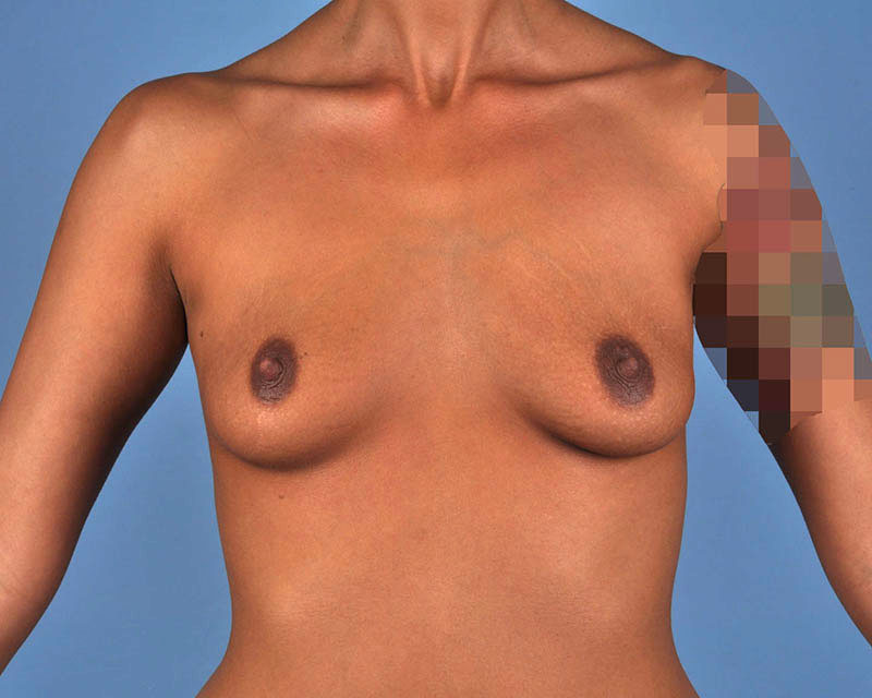 Breast Augmentation Before and After | Dr. Thomas Hubbard