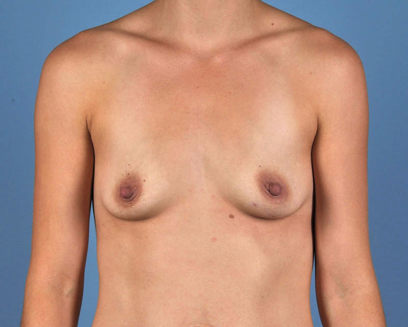 Breast Augmentation Before and After | Dr. Thomas Hubbard