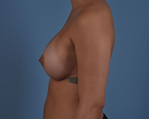 Breast Augmentation Before and After | Dr. Thomas Hubbard