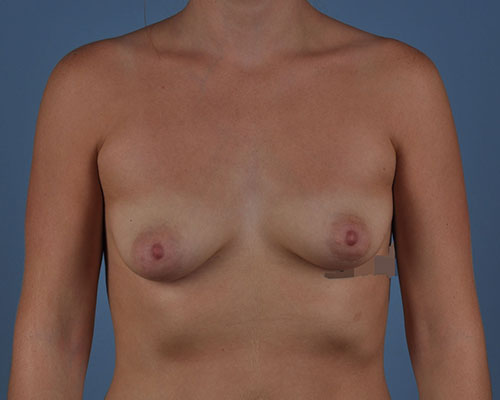 Breast Augmentation Before and After | Dr. Thomas Hubbard