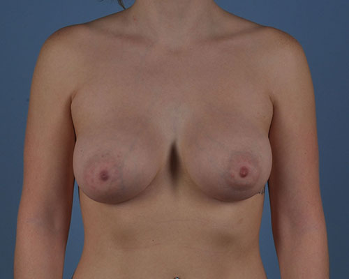 Breast Augmentation Before and After | Dr. Thomas Hubbard