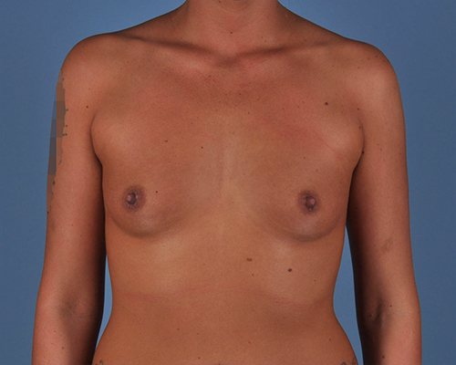 Breast Augmentation Before and After | Dr. Thomas Hubbard