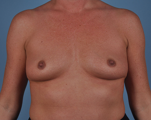 Breast Augmentation Before and After | Dr. Thomas Hubbard