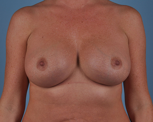 Breast Augmentation Before and After | Dr. Thomas Hubbard