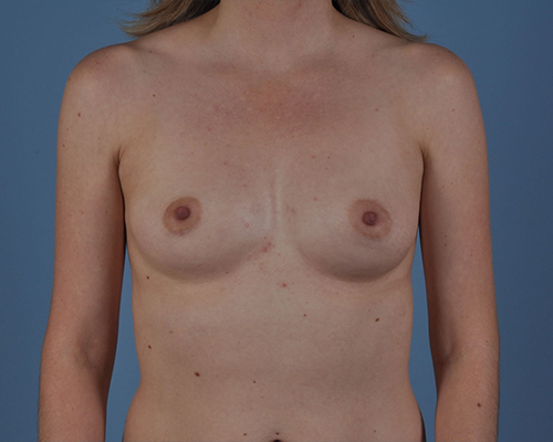 Breast Augmentation Before and After | Dr. Thomas Hubbard