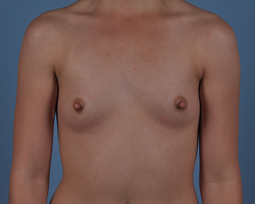 Breast Augmentation Before and After | Dr. Thomas Hubbard