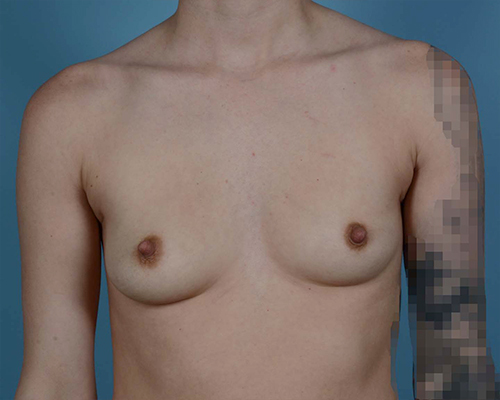 Breast Augmentation Before and After | Dr. Thomas Hubbard