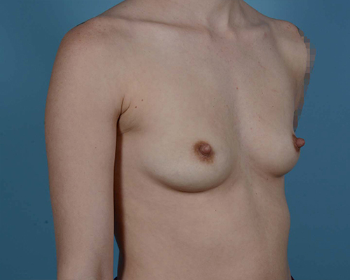 Breast Augmentation Before and After | Dr. Thomas Hubbard