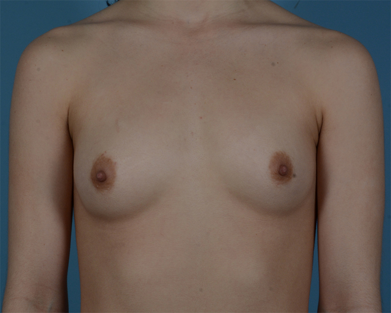 Breast Augmentation Before and After | Dr. Thomas Hubbard