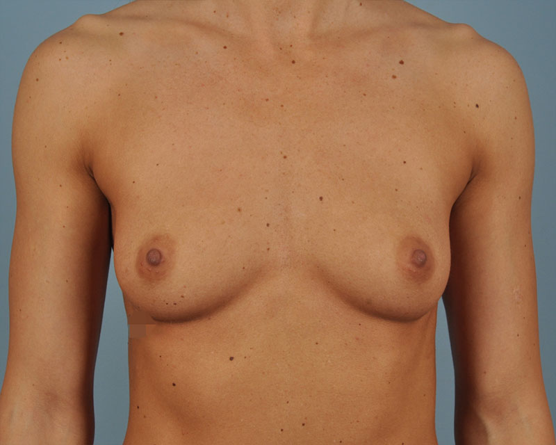 Breast Augmentation Before and After | Dr. Thomas Hubbard