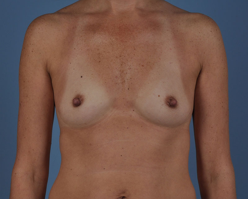 Breast Augmentation Before and After | Dr. Thomas Hubbard