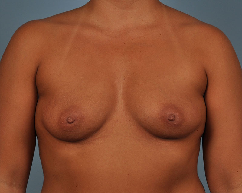 Breast Augmentation Before and After | Dr. Thomas Hubbard