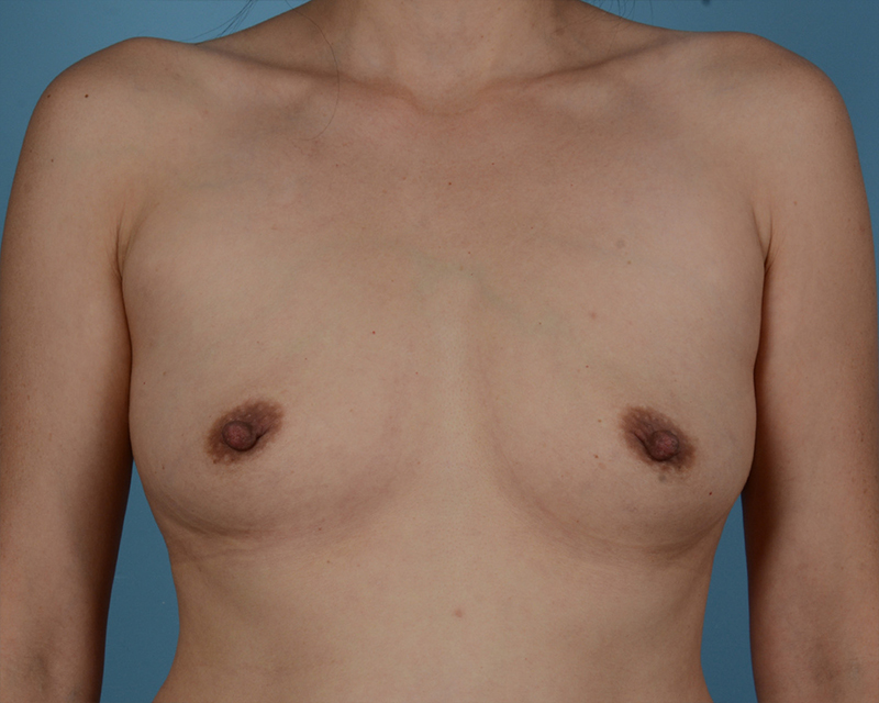 Breast Augmentation Before and After | Dr. Thomas Hubbard