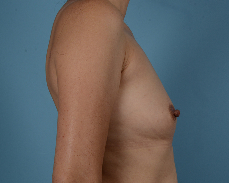 Breast Augmentation Before and After | Dr. Thomas Hubbard