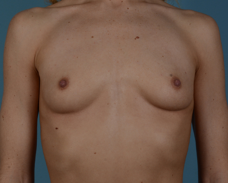 Breast Augmentation Before and After | Dr. Thomas Hubbard