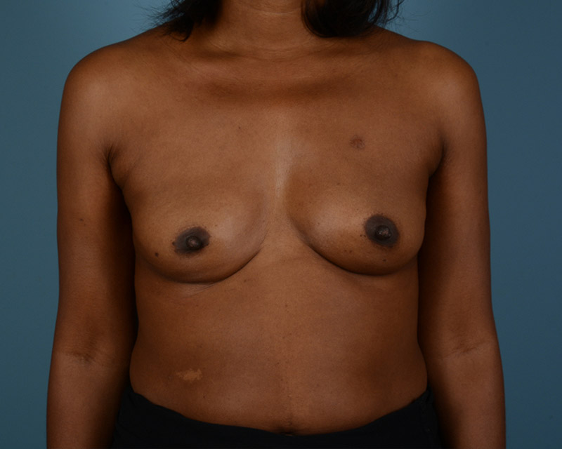 Breast Augmentation Before and After | Dr. Thomas Hubbard