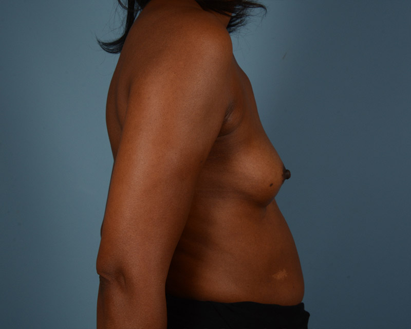 Breast Augmentation Before and After | Dr. Thomas Hubbard