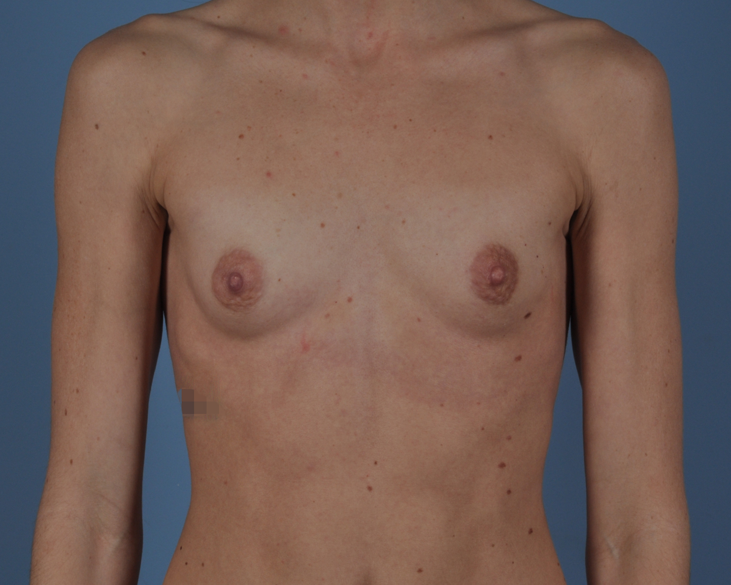 Breast Augmentation Before and After | Dr. Thomas Hubbard