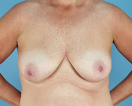 Breast Lift Before and After | Dr. Thomas Hubbard