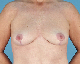 Breast Lift Before and After | Dr. Thomas Hubbard