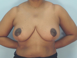 Breast Reduction Before and After | Dr. Thomas Hubbard