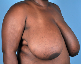 Breast Reduction Before and After | Dr. Thomas Hubbard