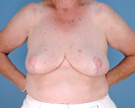 Breast Reduction Before and After | Dr. Thomas Hubbard