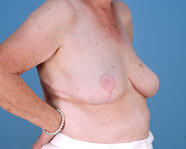 Breast Reduction Before and After | Dr. Thomas Hubbard