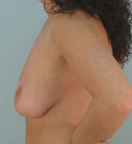 Breast Reduction Before and After | Dr. Thomas Hubbard