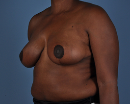 Breast Reduction Before and After | Dr. Thomas Hubbard