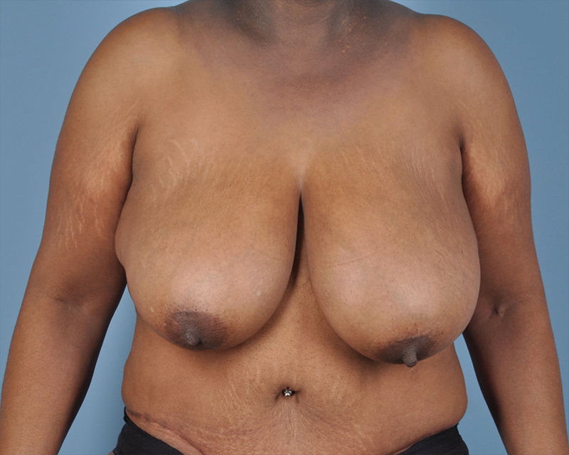 Breast Reduction Before and After | Dr. Thomas Hubbard