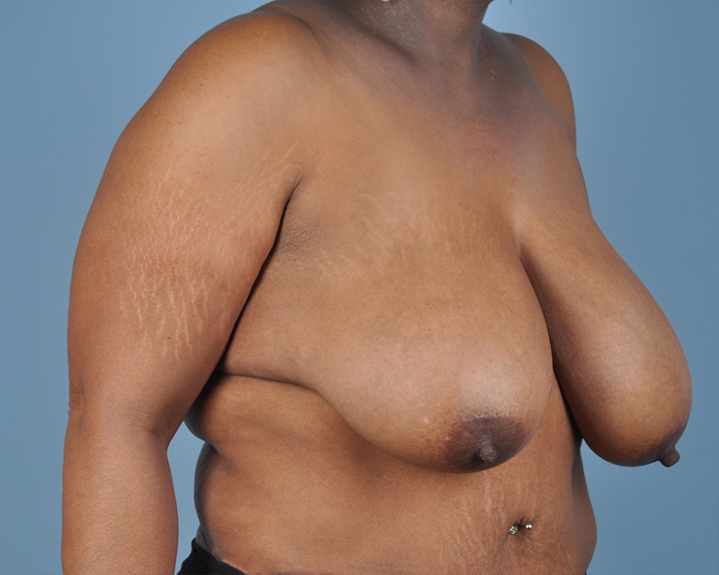 Breast Reduction Before and After | Dr. Thomas Hubbard