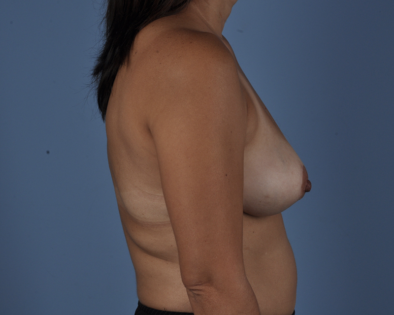 Breast Reduction Before and After | Dr. Thomas Hubbard