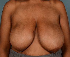 Breast Reduction Before and After | Dr. Thomas Hubbard