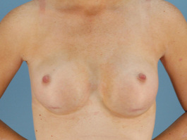 Breast Revision Before and After | Dr. Thomas Hubbard