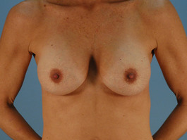 Breast Revision Before and After | Dr. Thomas Hubbard