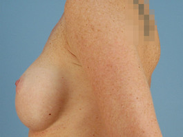 Breast Revision Before and After | Dr. Thomas Hubbard